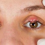 Làm gì để ngăn chặn chặn lẹo mắt tái phát?
