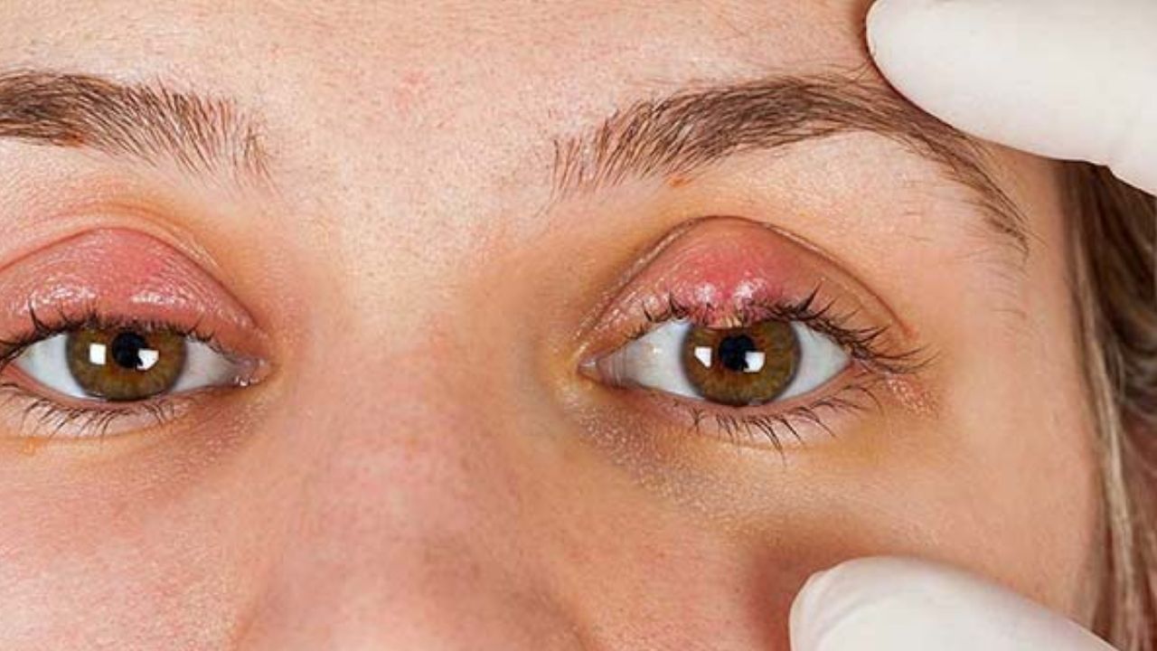 Các nguyên nhân gây ra lẹo mắt tái phát ở trẻ em là gì?

