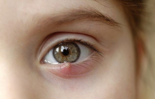 Cách chữa lẹo mắt ở trẻ