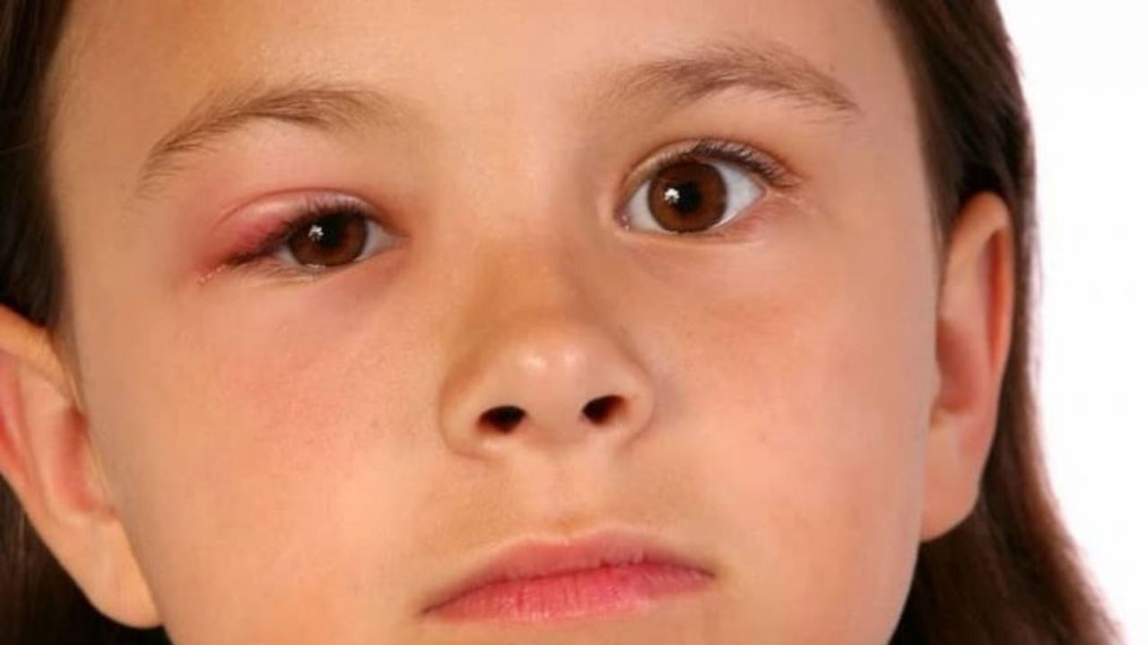 Trẻ sơ sinh bị lẹo mắt có những triệu chứng gì?
