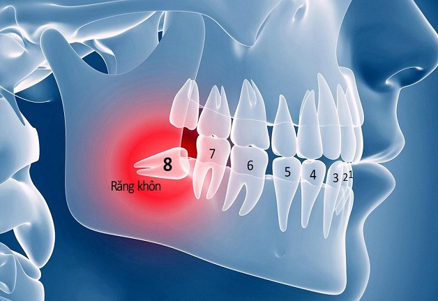 Răng khôn thường mọc ở những vị trí phức tạp, do đó mà quy trình nhổ răng cũng thường khó hơn so với các răng bình thường