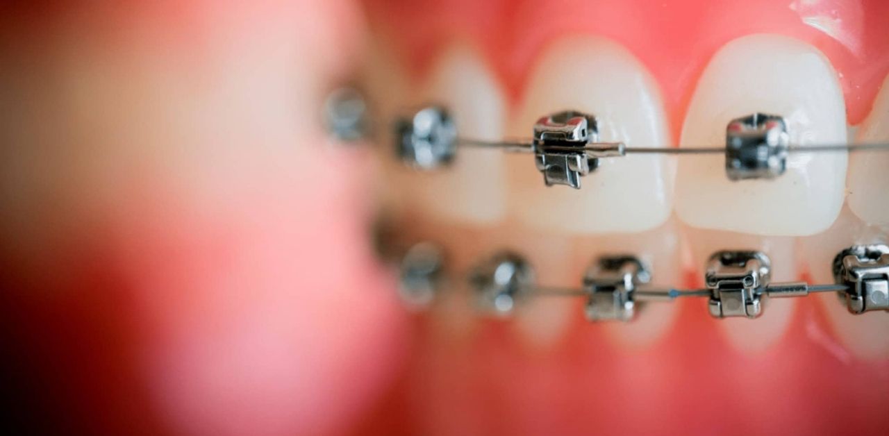Phương pháp niềng 2 răng cửa có nhanh hơn việc niềng toàn hàm không?
