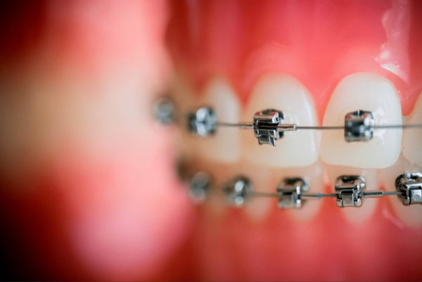 Niềng răng chỉnh nha là giải pháp hiệu quả khắc phục tình trạng hô răng cửa 