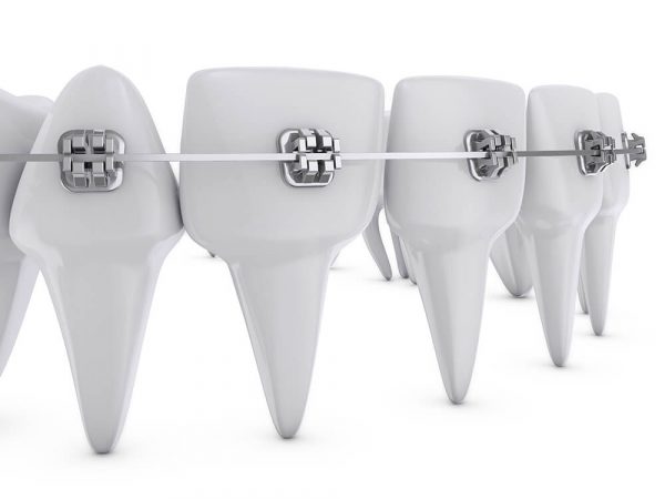 Niềng răng 1 hàm là phương pháp niềng chỉ gắn khí cụ chỉnh nha vào một hàm răng