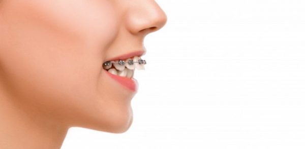 Niềng 1 hàm chỉ có thể áp dụng trong trường hợp răng lệch lạc, khấp khểnh nhẹ ở một hàm