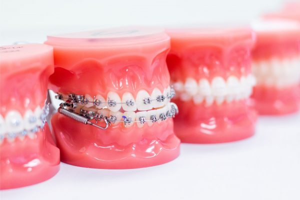 Có rất nhiều phương pháp niềng răng được áp dụng hiện nay để chỉnh nha cho trẻ em