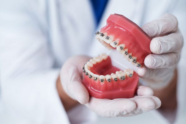 Chi phí niềng răng cho trẻ em giá bao nhiêu phụ thuộc nhiều vào phương pháp bác sĩ chỉ định