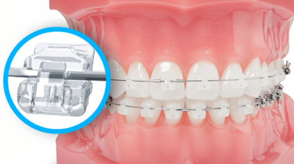 Niềng răng là một trong những phương pháp chỉnh nha hiện đại, khắc phục hiệu quả các vấn đề sai lệch ở răng