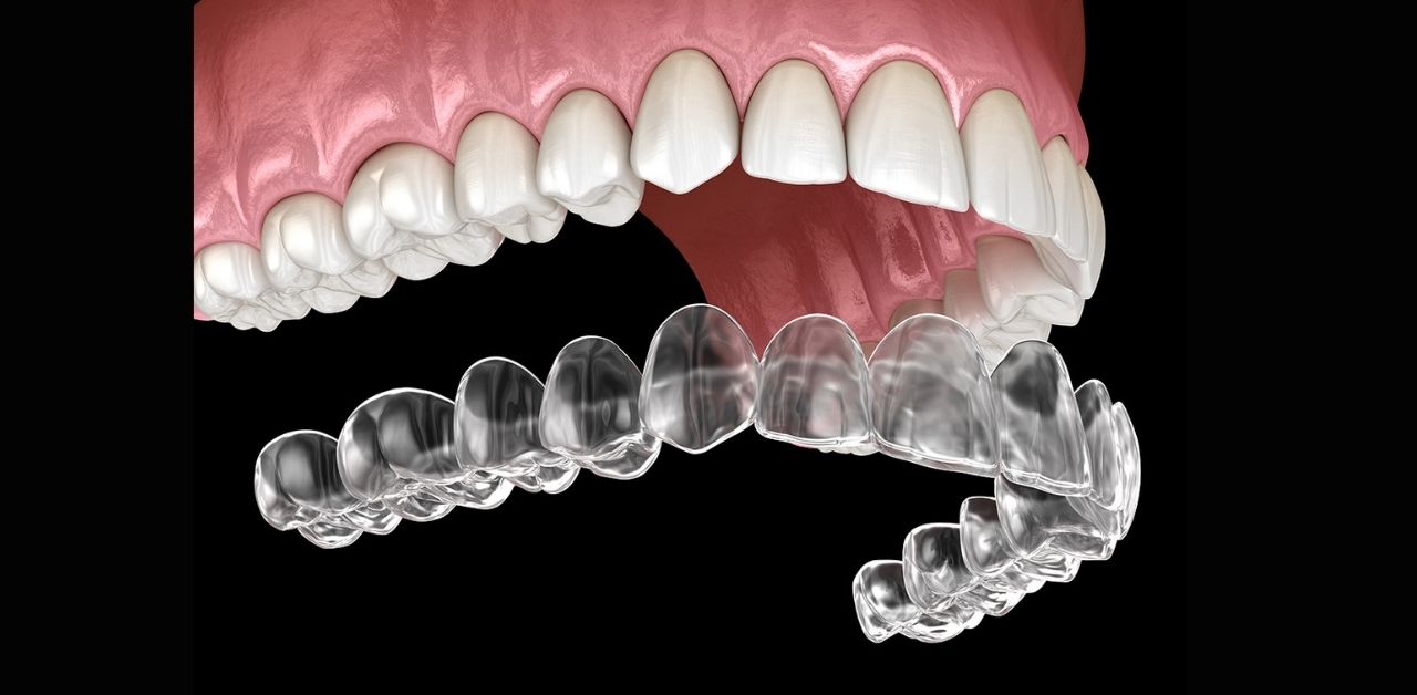 Tác động của niềng răng hô hàm trên đến khớp cắn?
