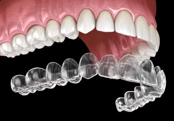 Phương pháp niềng răng hô hàm trên bằng khay niềng trong suốt hiện đại