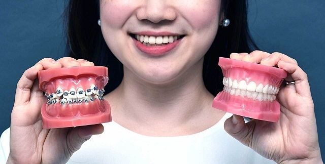 Niềng răng là phương pháp giúp nắn chỉnh răng, sắp xếp lại các răng về đúng vị trí