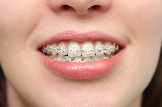 Niềng răng là phương pháp khắc phục những khuyết điểm của răng như răng hô, răng móm, răng thưa,.... 