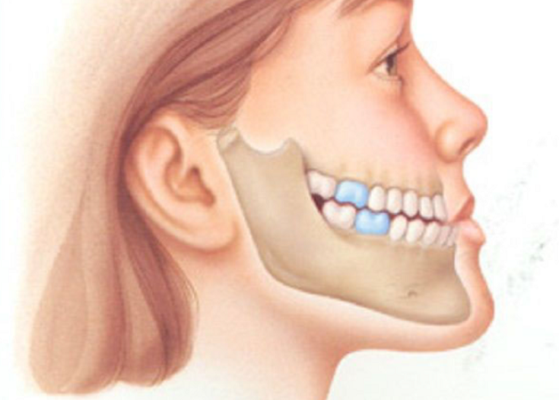 Những người bị răng móm thường ảnh hưởng đến tương quan khuôn mặt, khi nhìn nghiêng thì sẽ có cảm giác như mặt lưỡi cày