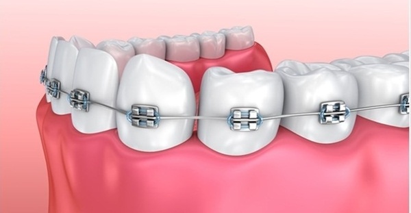Niềng răng là kỹ thuật nắn chỉnh răng sử dụng các khí cụ như mắc cài hay khay niềng 