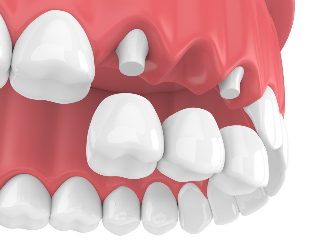 Phương pháp trồng răng giả cố định bằng cách làm cầu răng sứ