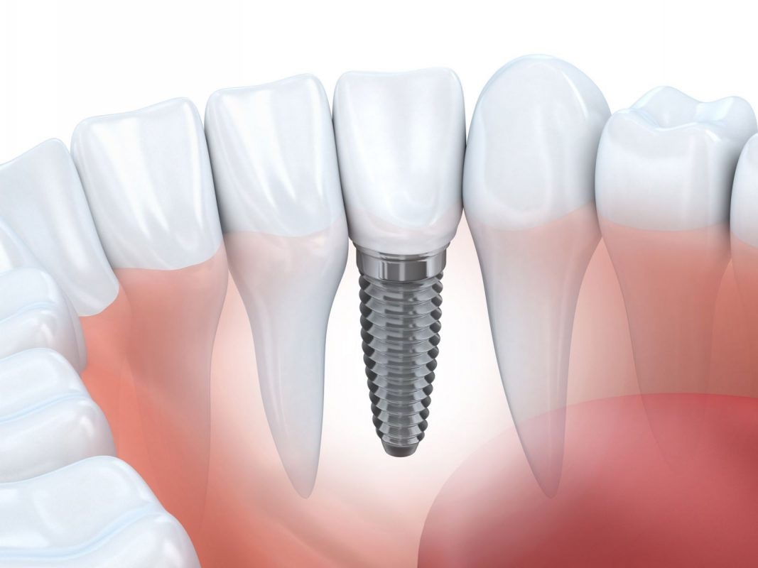 Phương pháp trồng răng Implant (cấy implant)