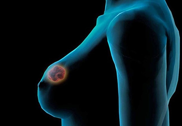Áp xe tuyến vú là hiện tượng xuất hiện một ổ viêm bên trong tuyến vú của mẹ