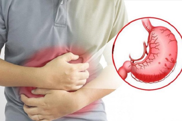 Bệnh viêm loét dạ dày có chữa khỏi được không?