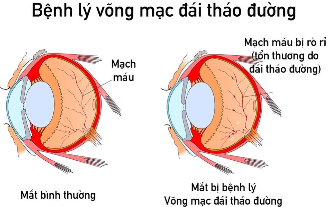 Liên quan giữa bệnh thần kinh, cơ tim và biến chứng mạch máu lớn của bệnh tiểu đường là như thế nào?