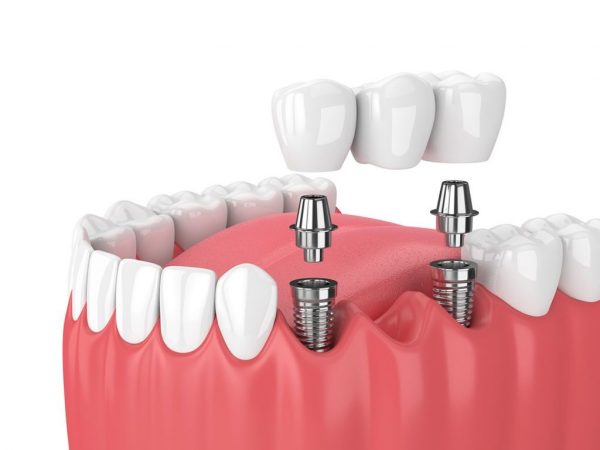 Khôi phục 1 răng đã mất bằng phương pháp cấy ghép Implant được nhiều bác sĩ nha khoa khuyên dùng