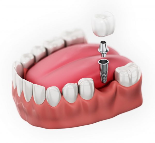 Trồng răng là giải pháp phục hình răng đã mất bằng những chiếc răng giả được làm từ các chất liệu đặc biệt.