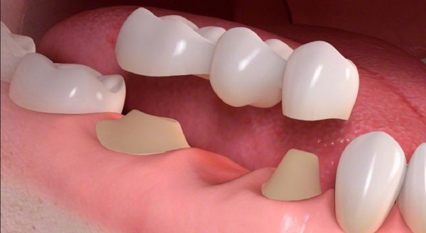 Trồng răng là phương pháp phục hình hiệu quả cho những trường hợp mất một hoặc nhiều răng 