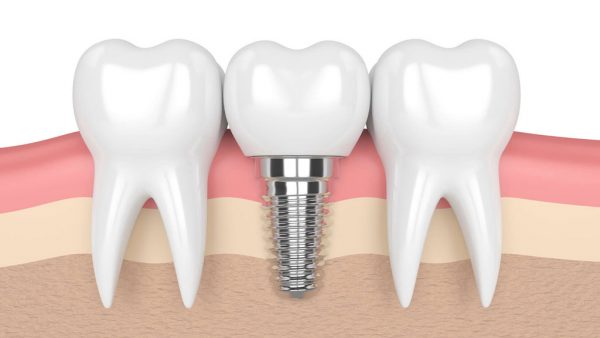 Trồng răng là phương pháp khắc phục tình trạng mất răng hàm do bệnh lý hoặc chấn thương gây ra