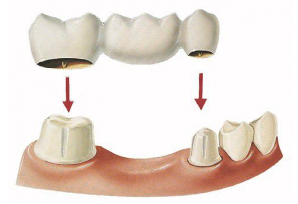 Trồng răng hàm bằng cầu răng sứ là phương pháp hiện đại, khôi phục khả năng ăn nhai như răng thật