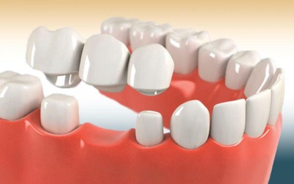Cầu răng sứ là giải pháp trồng răng hiện đại sử dụng cầu răng sứ được gắn trực tiếp lên răng thật