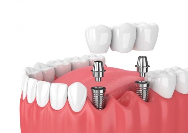 Cấy ghép Implant là giải pháp trồng răng phục hình hiện đại có thể khắc phục mọi khiếm khuyết của việc mất răng gây ra