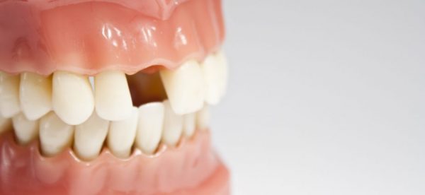 Răng bị mất về lâu dài có thể ảnh hưởng nghiêm trọng tới sức khỏe cũng như thẩm mỹ cho khuôn mặt