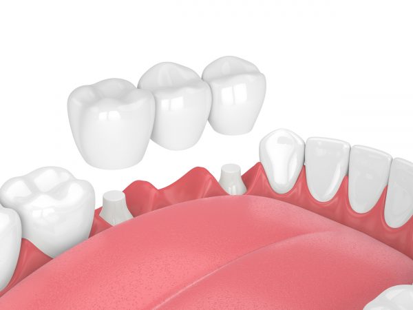 Răng sứ ở giữa có chức năng thay thế răng đã mất, hai răng kế cận sẽ làm trụ để nâng đỡ cả cụm mão sứ