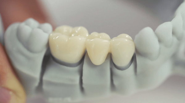 Trồng răng ngay khi răng bị mất hoặc nhổ bỏ để hạn chế tối đa những khiếm khuyết của việc mất răng gây ra