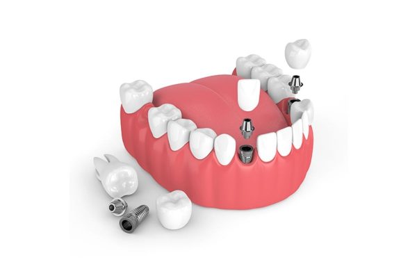 Kỹ thuật cấy ghép Implant sử dụng kết cấu răng bao gồm: Trụ Implant, mão sứ và khớp nối Abutment