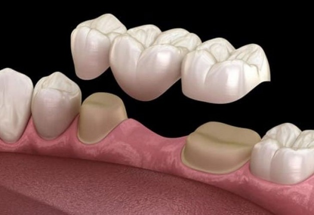 Trồng răng sứ là phương pháp thay thế cho những chiếc răng thật đã bị tổn thương mà khó có thể khôi phục được
