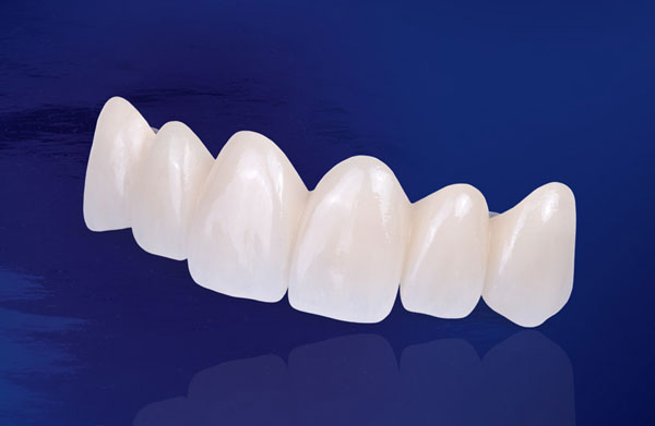 Trồng răng sứ giá rẻ nhất dao động trong mức khoảng hơn 2 triệu/răng