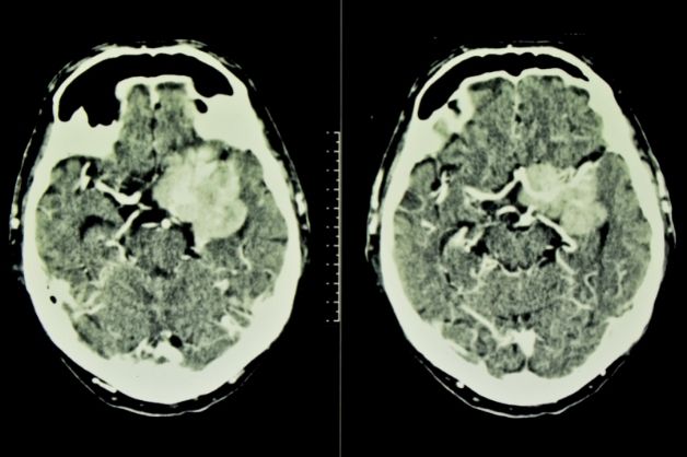 Kỹ thuật chụp X-quang giúp chẩn đoán hình ảnh u não 