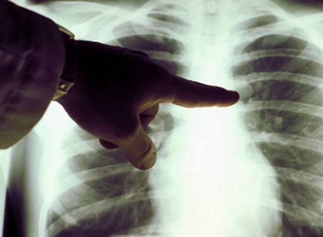 bệnh ung thư màng phổi là bệnh gì