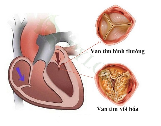 Vôi hóa van tim là bệnh gì?