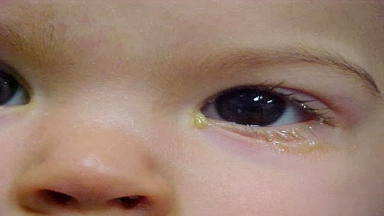 Ребенок температура слезятся глаза. Хламидийный конъюнктивит у новорожденных. Гонобленорейный конъюнктивит. Гонококковый конъюнктивит новорожденных.
