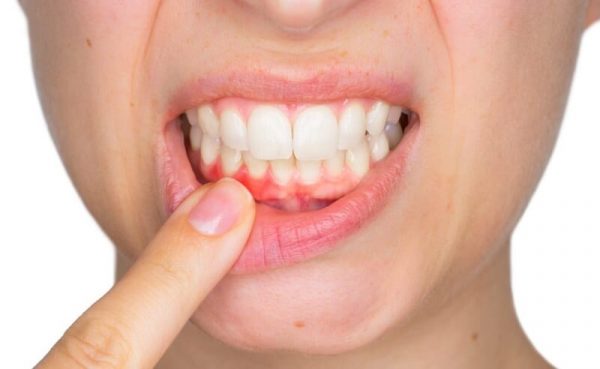 Viêm cuống răng là tình trạng mô răng quanh cuống răng bị tổn thương, gây nên tình trạng viêm nhiễm, đau nhức khi chạm vào