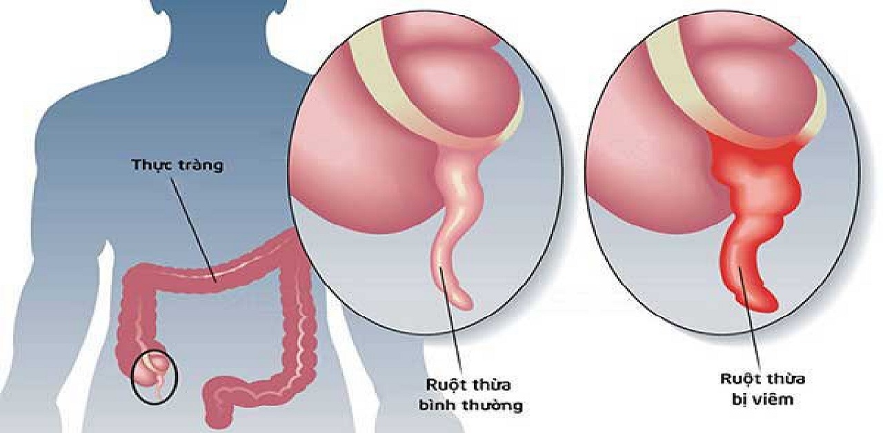 Cắt ruột thừa xuôi dòng là phương pháp điều trị nào cho bệnh nhân mắc ruột thừa?