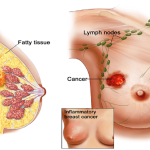 Gói khám – Nữ – Tầm soát phát hiện sớm ung thư vú