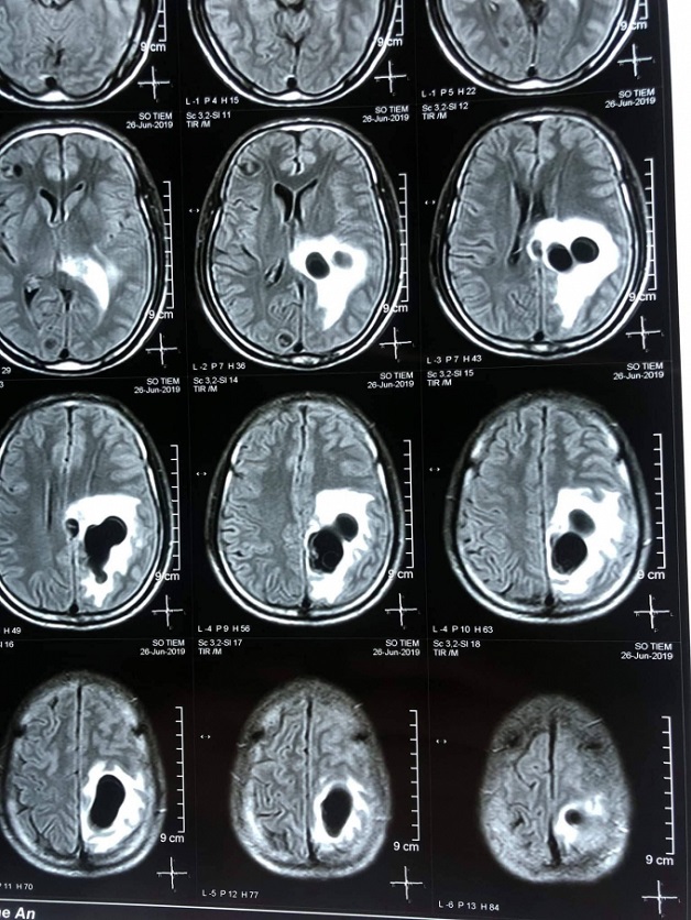 chụp CT não trong có tác dụng gì?