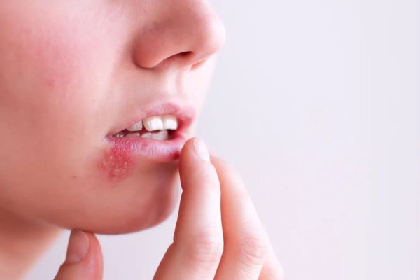 Bệnh Herpes ở môi do virus Herpes simplex (HSV) gây ra, khiến vùng da quanh miệng thường nổi mụn nước, đỏ, sưng tấy và đau nhức
