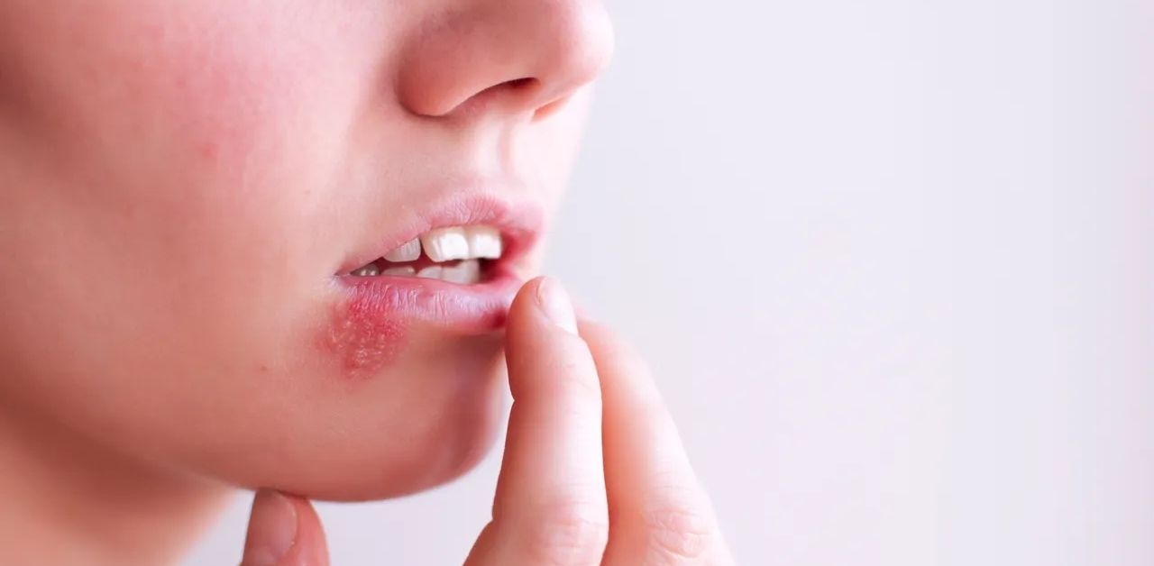Bệnh herpes môi có nguy hiểm không? 
