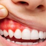 Biểu hiện viêm quanh cuống răng cần biết