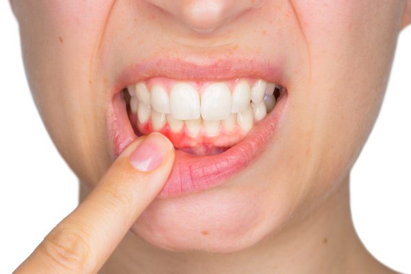 Viêm quanh cuống răng mãn tính không gây sốt nhưng có thể khiến răng ngả màu, đau nhức chân răng...