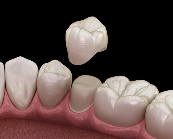 Bọc răng sứ là gì? Là một phương pháp thẩm mỹ nha khoa có chức năng phục hình hàm răng, giúp hàm răng trở nên thẩm mỹ hơn