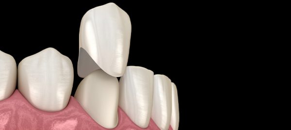 Tuổi thọ của răng sứ có thể kéo dài lên tới hơn 10 năm, phụ thuộc vào nhiều yếu tố